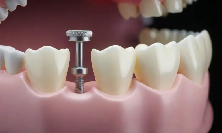 How To Remove Permanent Retainer Glue: A Comprehensive Guide